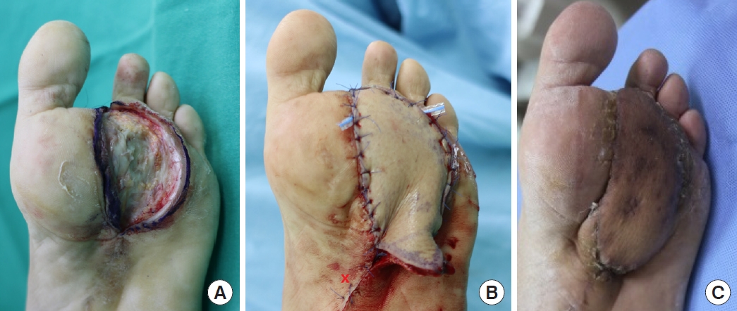 come across fireworks Institute Reconstruction of Plantar Forefoot in Diabetic Foot Ulcers: A Comparative  Study of Perforator Flaps and Random Flaps